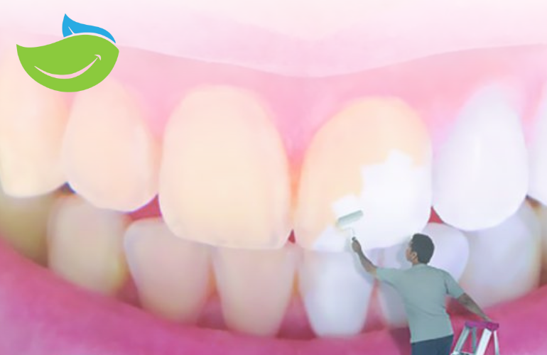 اصفرار الأسنان وتبييض الاسنان